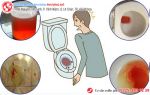 Mất thận vì sợ uống thuốc điều trị khi tiểu ra máu