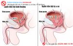 Ăn không ngon – ngủ không yên vì u xơ tuyến tiền liệt