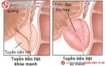 Viêm tuyến tiền liệt – ám ảnh mỗi khi đêm về
