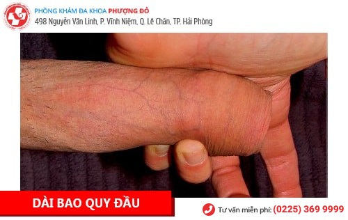 Bệnh Dương Vật Là Gì? Cách Chữa Trị Hiệu Quả Hiện Nay