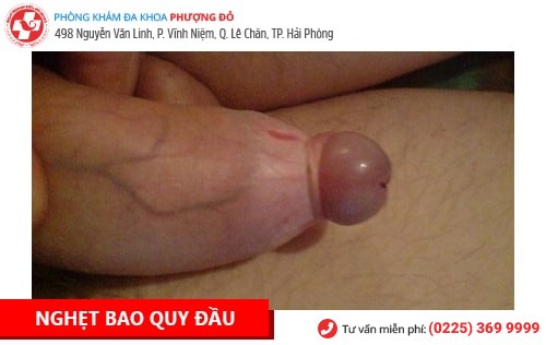 Bệnh Dương Vật Là Gì? Cách Chữa Trị Hiệu Quả Hiện Nay