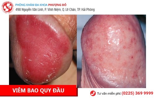 Bệnh dương vật là gì? Cách chữa trị hiệu quả hiện nay