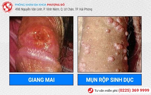 Bệnh Dương Vật Là Gì? Cách Chữa Trị Hiệu Quả Hiện Nay