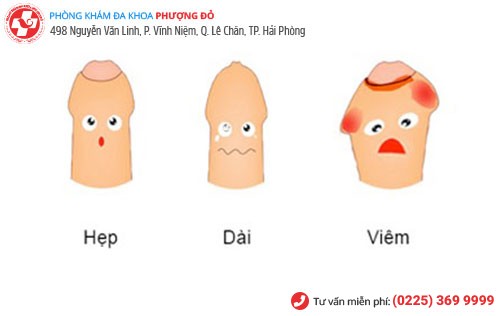 Bệnh bao quy đầu