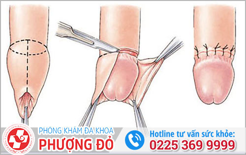 Phương Pháp Điều Trị Viêm Bao Quy Đầu Hiệu Quả