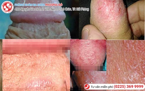 Hình ảnh da bao quy đầu bị khô