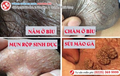 Ngứa bìu tinh hoàn là dấu hiệu nhiều bệnh nguy hiểm