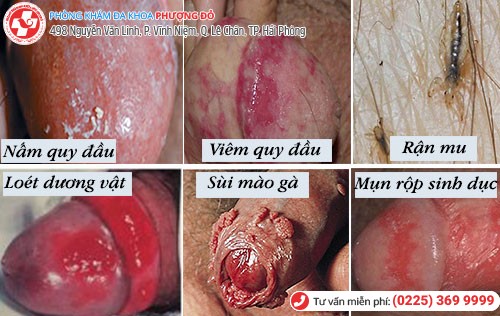 Viêm bao quy đầu