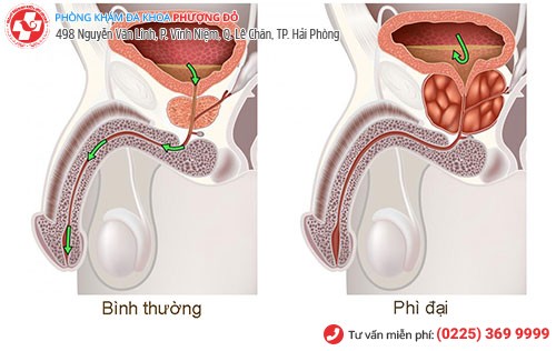 biểu hiện phì đại tuyến tiền liệt