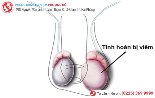 biểu hiện viêm tinh hoàn