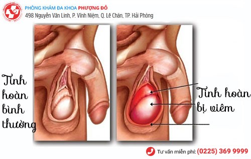 biểu hiện viêm tinh hoàn