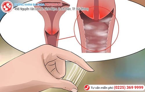 Viêm âm đạo là nguyên nhân gây ra sưng âm đạo Viêm âm đạo là nguyên nhân gây ra sưng âm đạo