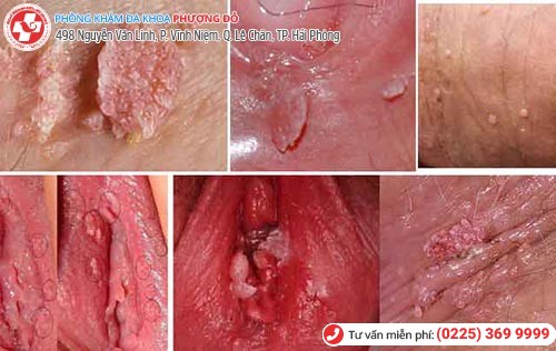 Hình ảnh nổi mẩn đỏ vùng kín Hình ảnh nổi mẩn đỏ vùng kín