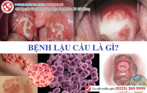 Lậu do song cầu khuẩn lậu Neisseria gonorrhoeae gây nên Lậu do song cầu khuẩn lậu Neisseria gonorrhoeae gây nên
