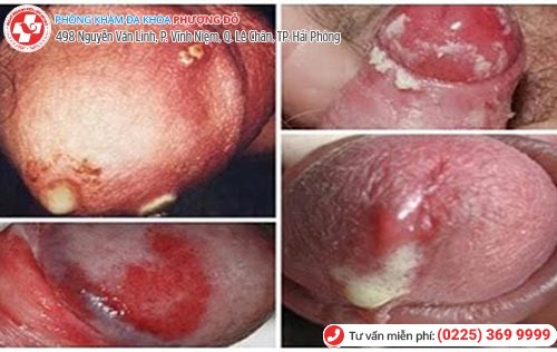 Hình ảnh bệnh lậu ở nam Hình ảnh bệnh lậu ở nam
