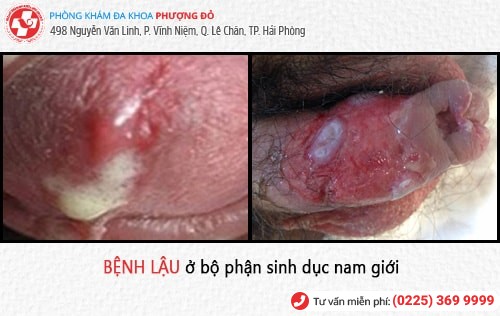 dấu hiệu bệnh lậu