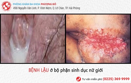 dấu hiệu bệnh lậu