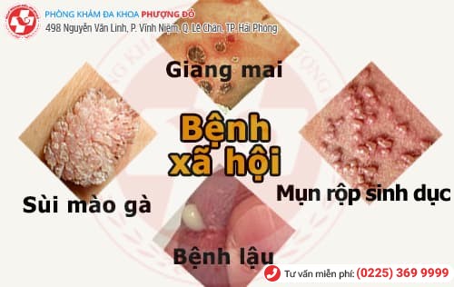 triệu chứng, dấu hiệu bệnh xã hội triệu chứng, dấu hiệu bệnh xã hội