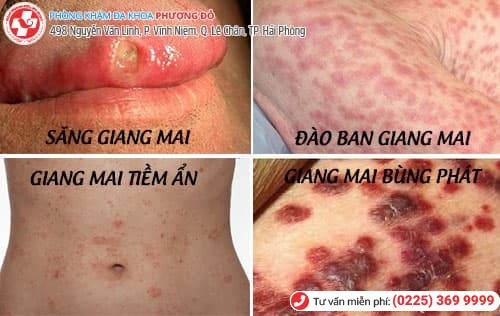 các giai đoạn giang mai