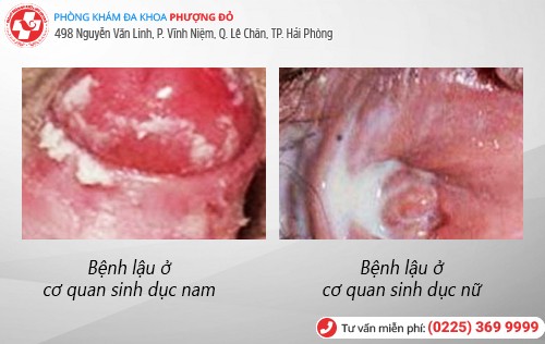 Tư vấn - Bệnh lậu có chữa được không?