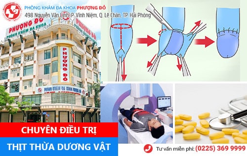 Nam giới cần cảnh giác với thịt thừa dương vật Nam giới cần cảnh giác với thịt thừa dương vật