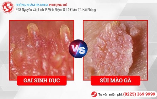 Hình ảnh gai sinh dục Hình ảnh gai sinh dục