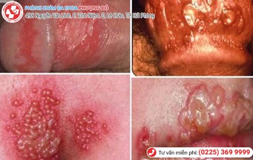 Herpes sinh dục