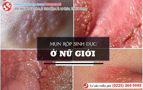 Mụn sinh dục ở nữ