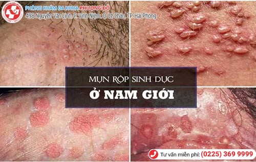 Mụn sinh dục nam