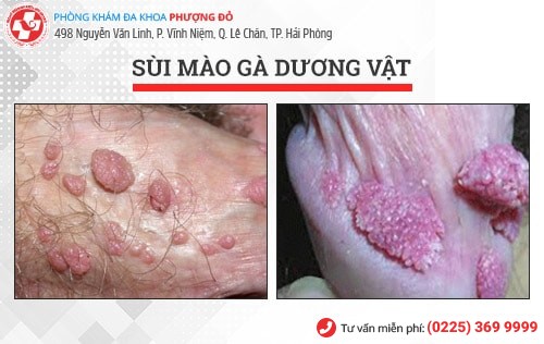 sùi mào gà dương vật