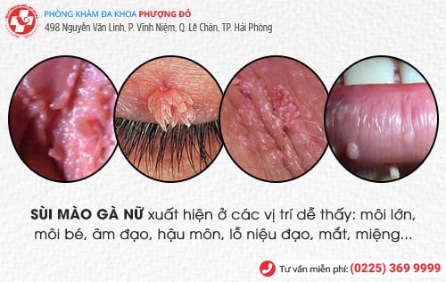 sùi mào gà nữ