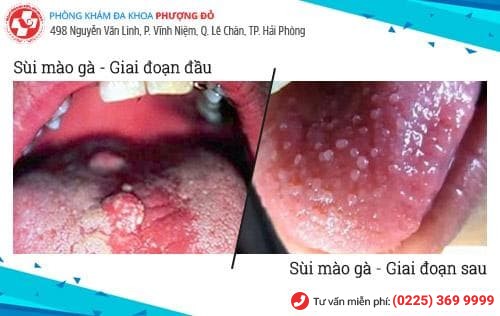 sùi mào gà ở miệng