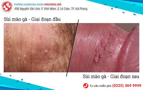 sùi mào gà ở nam