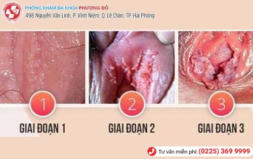 sùi mào gà ở nữ