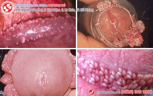 Nam giới cần cảnh giác với thịt thừa dương vật Nam giới cần cảnh giác với thịt thừa dương vật