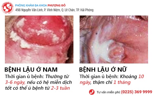 thời gian ủ bệnh lậu