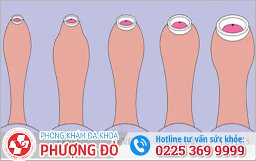 Hẹp bao quy đầu ở nam giới là gì?